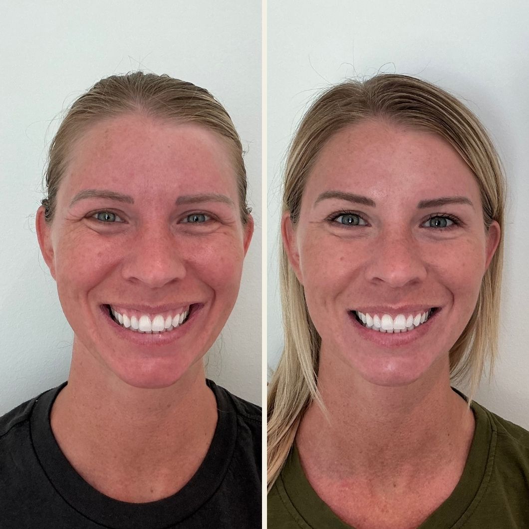 smile line filler results at Self Skin Studio in Wilmington, NC