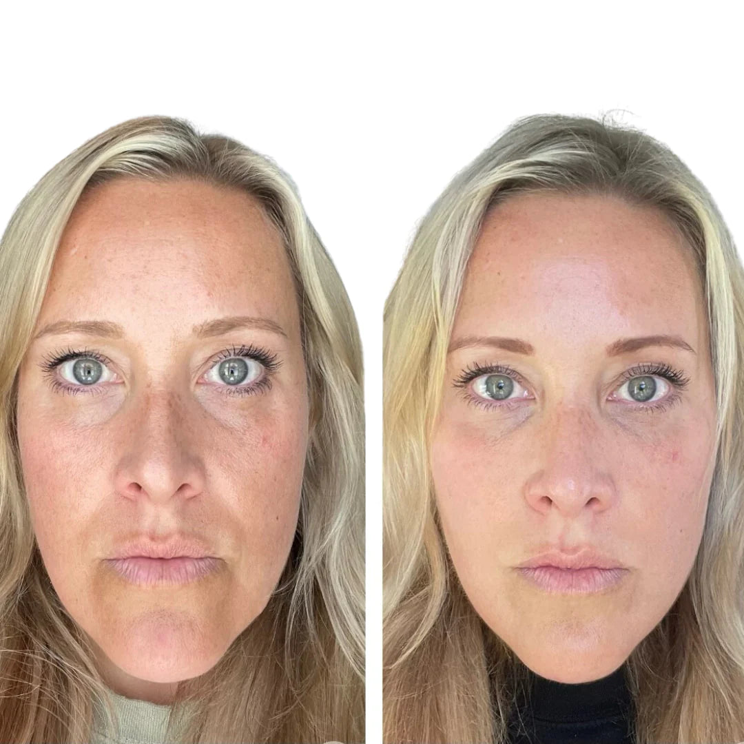 Fillers Treatment - Before & After