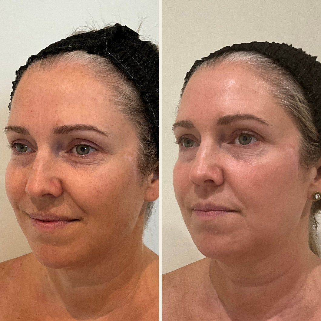 Before and after for a laser for sun damage