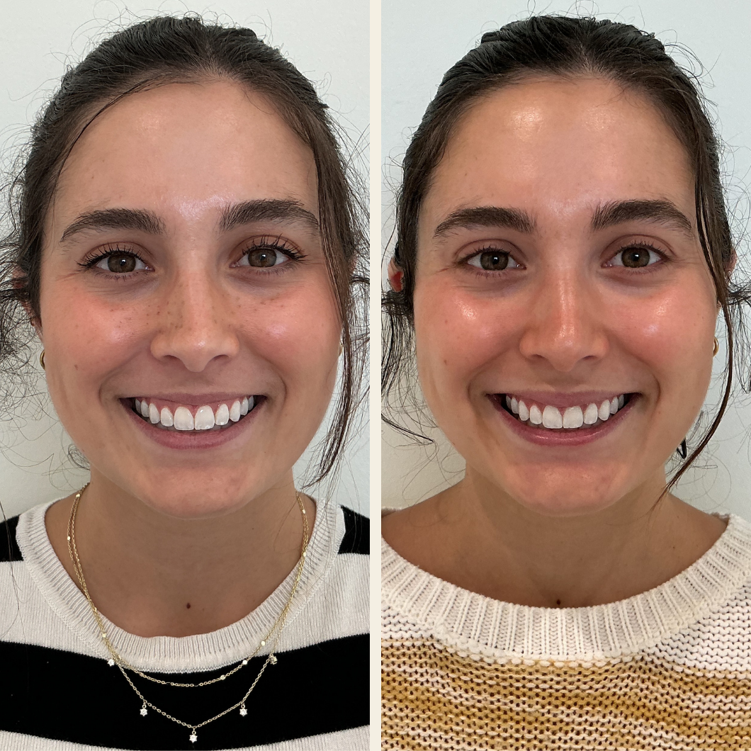 Botox Lip flip at Self Skin Studio in Wilmington, NC