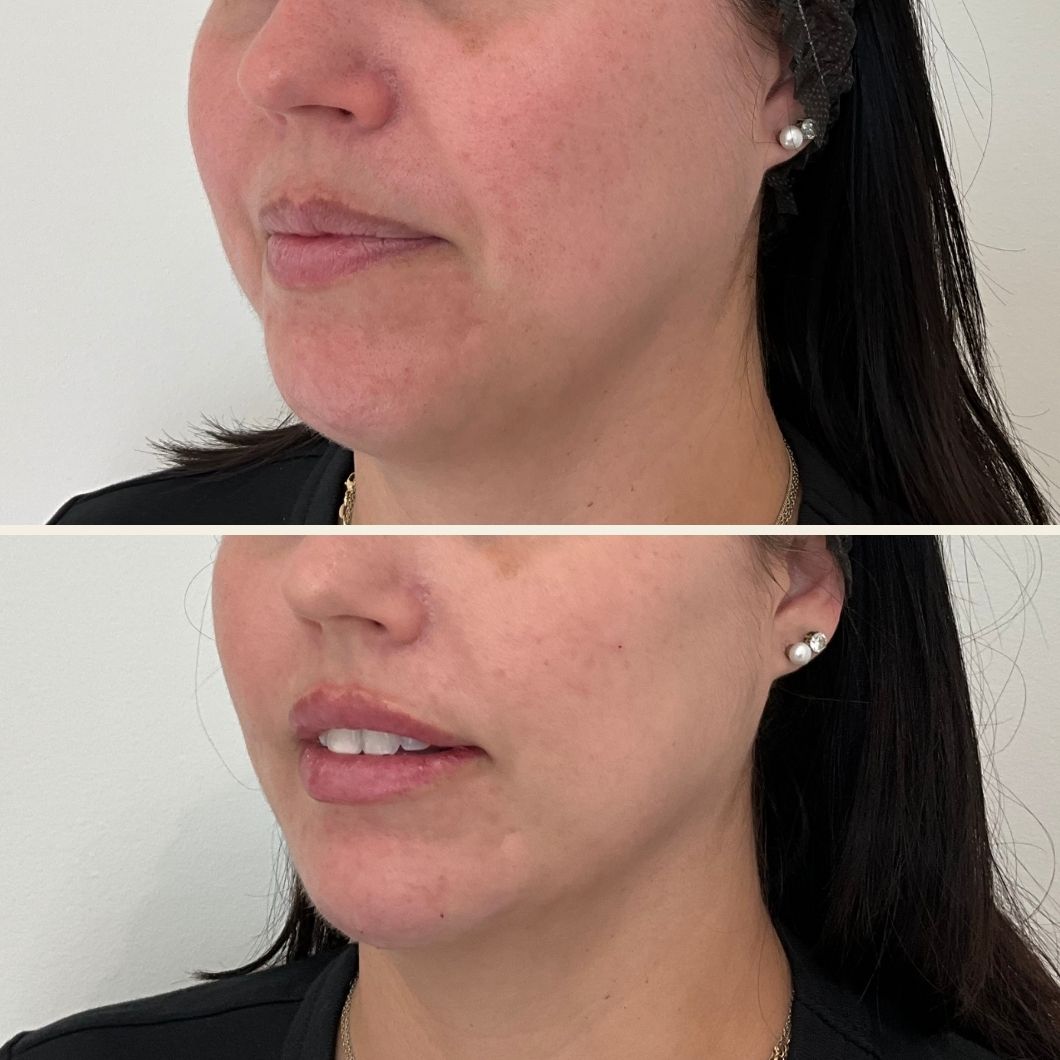 jawline filler results at Self Skin Studio in Wilmington, NC