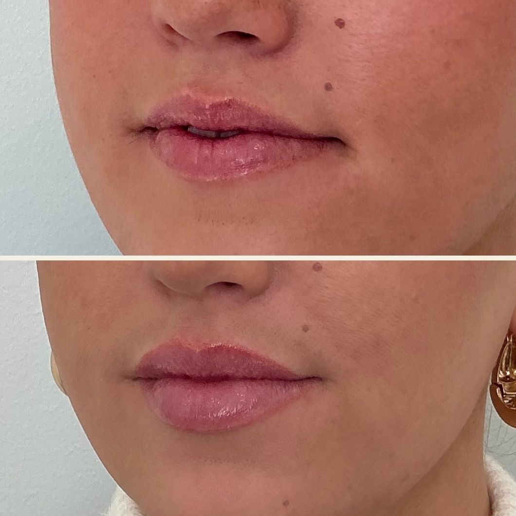 Lip filler before and after results at Self Skin Studio in Wilmington NC