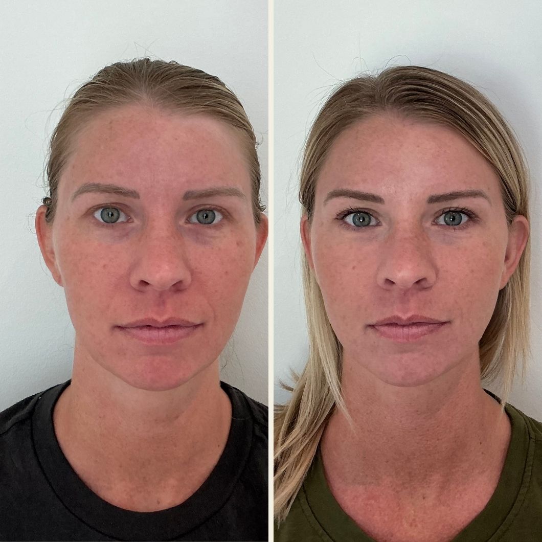 Smile line filler results at Self Skin Studio in Wilmington, NC