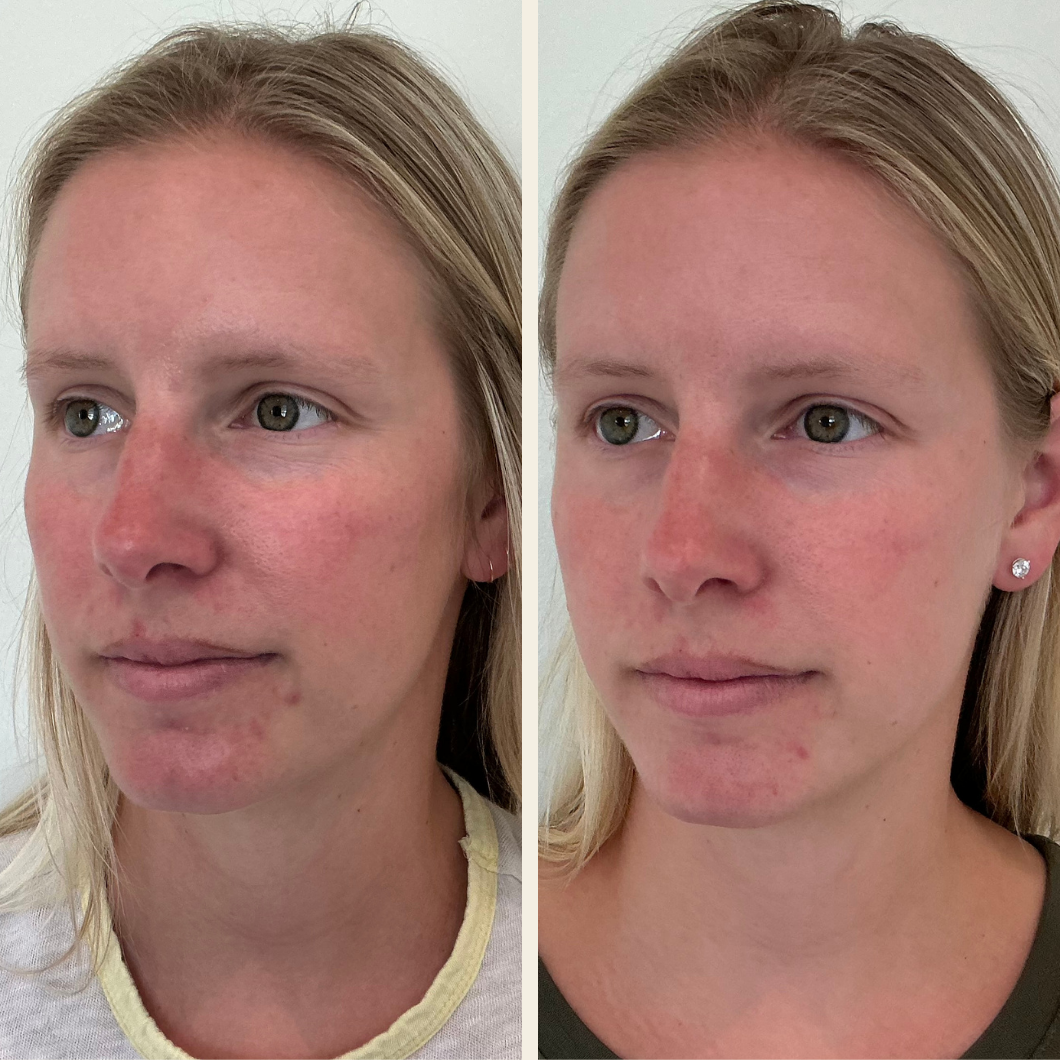 before and after of skincare results at Self Skin Studio in Wilmington, NC